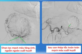 Đi ngoài phân đen bệnh nhân ung thư dạ dày sốc mất máu, suy đa cơ quan
