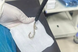 Bệnh nhi 2 tuổi nuốt lắc bạc vào dạ dày