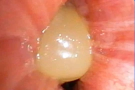 Ăn ngô bị sặc, người phụ nữ 60 tuổi suy hô hấp nguy kịch