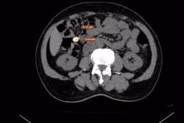 Nhiều năm uống thuốc sỏi thận không ngờ là nốt vôi hóa