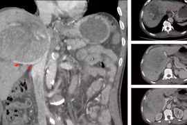 Hành trình giành sự sống cho người bệnh ung thư gan 'tiên lượng 9 tháng'