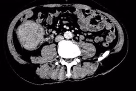 Mệt mỏi, đi ngoài phân đen không ngờ ung thư đại tràng di căn gan