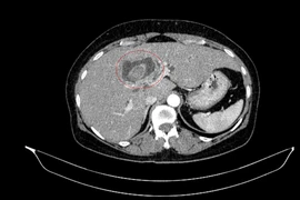 Vàng da người phụ nữ đi khám, phát hiện ca bệnh hiếm, hai ung thư nguyên phát