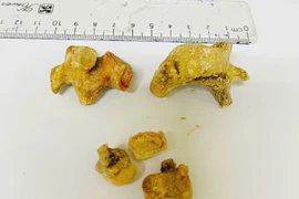 Đau quặn bụng người phụ nữ bị sỏi san hô lớn gây giãn đài bể thận