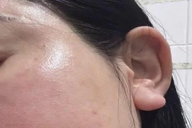 Tiêm meso tại nhà người phụ nữ bị u hạt nhiễm khuẩn nặng