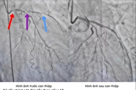 Đau ngực dữ dội, 2 lần ngừng tim liên tiếp do tắc mạch máu chính