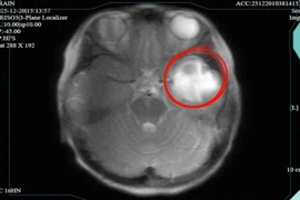 Buồn nôn đi khám, bé gái 9 tuổi bị áp xe não, phù não lan rộng