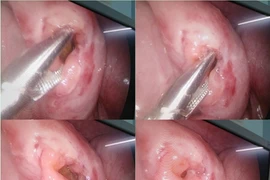 Bé trai 6 tuổi tím bụng, vỡ ruột khi đi xe đạp điện với bạn