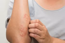 Viêm mao mạch dị ứng, nhận biết đúng để phòng tránh biến chứng