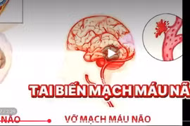 Bác sĩ mách cách dự phòng bệnh mạch vành do tăng huyết áp