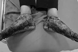 Ngâm nước lá nóng điều trị viêm da cơ địa, người bệnh bị bỏng nặng hai chân