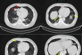 Người đàn ông 63 tuổi mắc đồng thời ung thư phổi và tuyến tiền liệt
