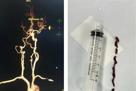 Đi viện điều trị đau bụng, cụ bà 75 tuổi đột quỵ