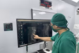 Chấn thương hiếm gặp, đốt sống trượt hoàn toàn sau cú ngã từ trên cao