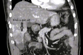 Đau hạ sườn 1 ngày, người đàn ông vỡ u gan nguy kịch