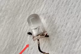 Thót tim xử trí cấp cứu bé 9 tháng tuổi sặc bóng đèn led vào phế quản