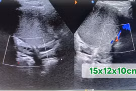 Gái trẻ chưa chồng bụng dưới to, căng do u khủng