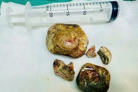 Tiểu buốt, đau tức mạn sườn do sỏi bàng quang kích thước lớn