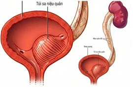 Nội soi không vết mổ giải cứu bé trai 6 tháng tuổi nhiễm trùng tiểu nặng