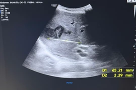 Lấy tăm ngậm xuyên vào gan cho người bệnh 65 tuổi