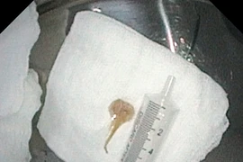 Khó thở kéo dài không ngờ xương cá lóc trú trong đường thở 2 tháng