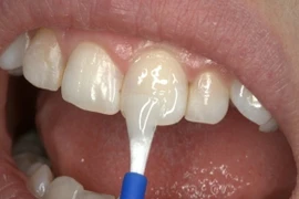 Ứng dụng của Varnish fluoride trong dự phòng sâu răng