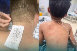 Gần 300 con ong mật đốt, 2 cha con nhập viện cấp cứu