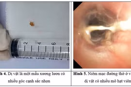 Dị vật 'bị bỏ quên' hơn 1 tháng trong phế quản bé trai 3 tuổi 
