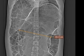 Nam sinh 18 tuổi cắt hơn nửa mét ruột do xoắn đại tràng sigma