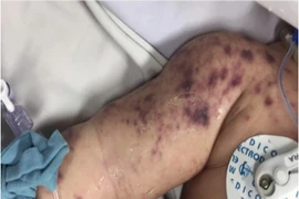 Một bệnh nhi tử vong do viêm não mô cầu nhóm B, có nên đổ xô đi tiêm phòng?