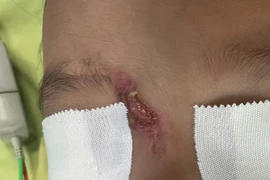 Rò rễ mũi bẩm sinh tạo khối áp xe lớn lan rộng ở trẻ sơ sinh