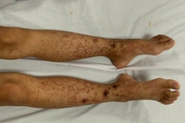 Trẻ nổi ban, đau bụng cẩn thận bệnh Schönlein–Henoch nguy hiểm