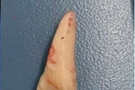 Tai nạn xe đạp điện, trẻ 10 tuổi phải mổ lấy dị vật răng trong đường thở