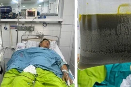 Thoát khỏi cơn nguy kịch do suy gan cấp nhờ kỹ thuật tách huyết tương 