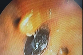 Ho, khó thở kéo dài do hạt hồng xiêm trú ngụ 4 tháng trong phế quản