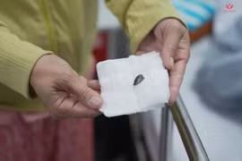 Ho kéo dài điều trị không khỏi do hạt hồng xiêm trong phế quản