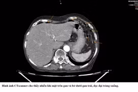 Nhiều người viêm phúc mạc do thủng tạng rỗng vì bỏ qua triệu chứng