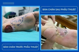 Bỏng ống xả xe máy phải phẫu thuật chuyển vạt che gót chân biến chứng
