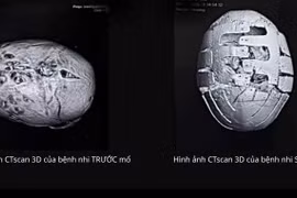 Sửa hẹp sọ bẩm sinh phục hồi diện mạo, bảo vệ não bộ cho trẻ