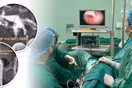 Giành lại thiên chức làm mẹ cho người phụ nữ dính buồng tử cung sau nạo thai