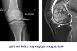 Chủ quan đau âm ỉ khớp gối, người đàn ông phát hiện u tế bào khổng lồ