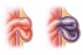 Một lần làm vườn, suýt mất ruột, biến chứng nguy hiểm của thoát vị bẹn