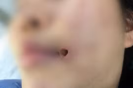 1 năm sau tiêm filler, cô gái 21 tuổi viêm tấy mặt do tụ cầu vàng