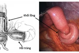 Cảnh báo lồng ruột ở trẻ nhỏ, cách xử trí