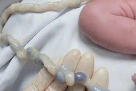 Dây rốn thắt nút sinh thường vẫn an toàn nếu được xử lý chuẩn