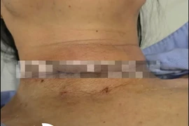 Can thiệp ống ngực chữa rò dưỡng chấp sau mổ tuyến giáp