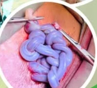 'Tết tóc' bằng dây rốn trong bụng mẹ và cuộc giải cứu kịp thời ở tuần 30