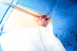 Bé 5 tuổi bị kén bã đậu bội nhiễm nặng do nhầm nốt mụn