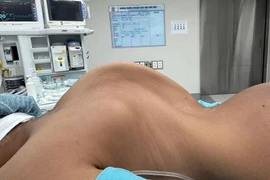 2 bé gái cao thêm 10 cm nhờ phẫu thuật chỉnh gù vẹo cột sống nặng hiếm gặp