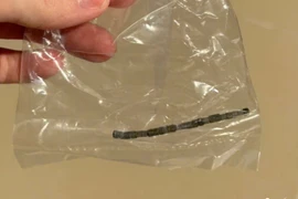 Phát hiện 24 viên nam châm rỉ sét trong bụng bé trai 3 tuổi